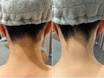 フェイシャルクレア(Cre A.)/うなじ脱毛【Mパーツ】