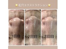 プルナモ(Purnama)/毛穴エクストラション