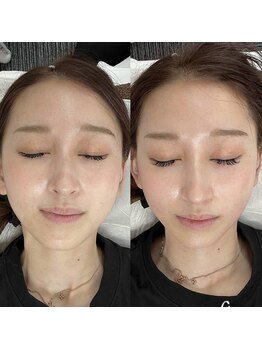 リリー(LILLY)/症例