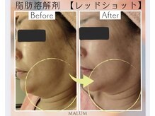 マールム(MALUM)の雰囲気（脂肪を減少 レッドショットが「フェイスライン」などをタイトに）