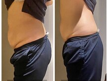 サンタイ(santai.)/Wキャビでしつこい脂肪を分解