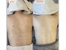 ツルピカ背中に！背中マツヤニ+クレイパック【背中上もしくは背中下】