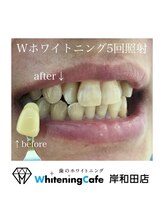 ホワイトニングカフェ 岸和田店(WhiteningCafe)/Wホワイトニング5回照射