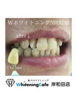 ホワイトニングカフェ 岸和田店(WhiteningCafe)/Wホワイトニング5回照射