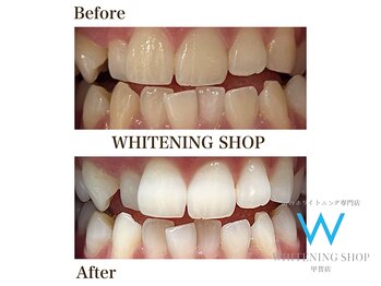 ホワイトニングショップ 甲賀店/Before&After『ホワイトニング』