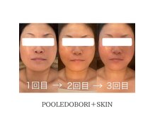プール エドボリ(POOL EDOBORI)の雰囲気（◇小顔/お肌/毛穴洗浄などお気軽にご相談ください。）