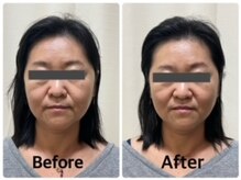 まごころ整骨院の雰囲気（電気美容鍼＋小顔矯正before＆after(1回施術)）