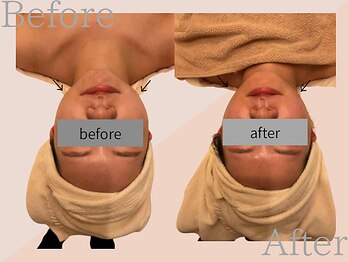 ファミーユ 名古屋店/【骨切り後ビフォーアフター】