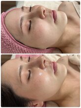 アネラ(ANERA)/韓国肌管理！水光ピーリング