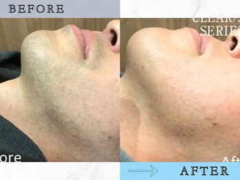 ラッシュ(RUSH)/8ヶ月でヒゲ脱毛完了!