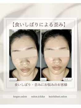 イチカ 仙川店( ichika)/食いしばりによる歪み