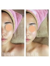 リベラ(Re:BELLA)/本格小顔コルギ＆石膏パック