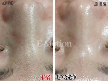 エモーション(E Motion)/最先端★ハイドロスキン毛穴洗浄
