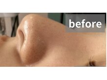 ドクターエイチ 四ツ橋堀江店(Doctor.H)/ハイドロピーリング（毛穴洗浄）