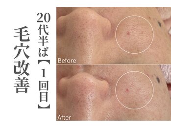 エトレ(etre)の写真/【毛穴の黒ずみ・開きを徹底洗浄】強炭酸で毛穴撃退！カーボキシーで理想のつる艶肌へ☆