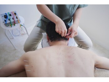 ビファイン鍼灸治療院 代々木上原院の写真/【慢性的な腰痛・肩こりを解消したい方に☆】極細鍼を使用するので痛みが少なく初めての方にもオススメ♪