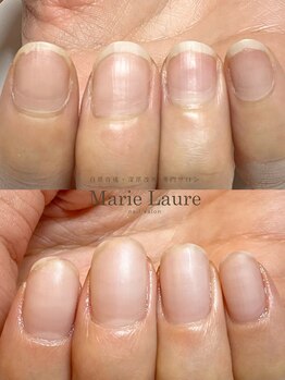 マリーロール 梅田店(Marie Laure)/自爪育成/深爪矯正/ネイルケア