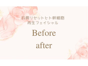 ミラー(MIRAOR)/美肌質ヒト幹細胞☆BefAft