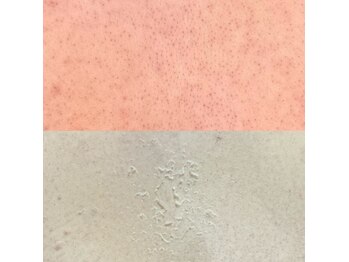 サロン ハリー(SALON HARRY)/背中のハーブピーリング