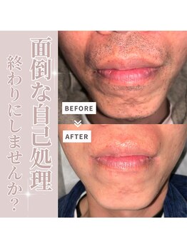 メンズラボ 京都駅前店/ヒゲ脱毛でワンランク上の美肌へ