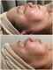 エステティックサロン ローブ(ESTHETIC SALON LAUB)の写真/話題の《脂肪分解》美容液が韓国から上陸！⇒【劇的たるみ改善★レモンボトル全顔3CC/¥22,000⇒¥12,100】