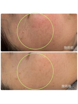 チョチョワンプラス(緒々one+)/顔の赤みでお悩みの方に