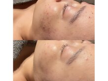 アンドコー(&.Co)の雰囲気（【フェイシャル施術】肌質改善（ニキビ改善））