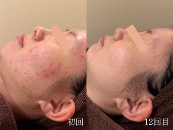 ウォーム(warm)/ニキビケア/肌荒れ/ニキビ肌