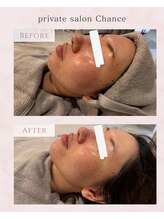 シャンス(Chance)/ピーチリフト　症例1回目