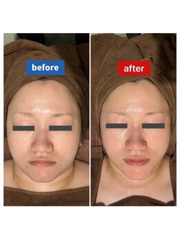 サロン ド メタセコイア(salon de Metasequoia)/フェイシャル