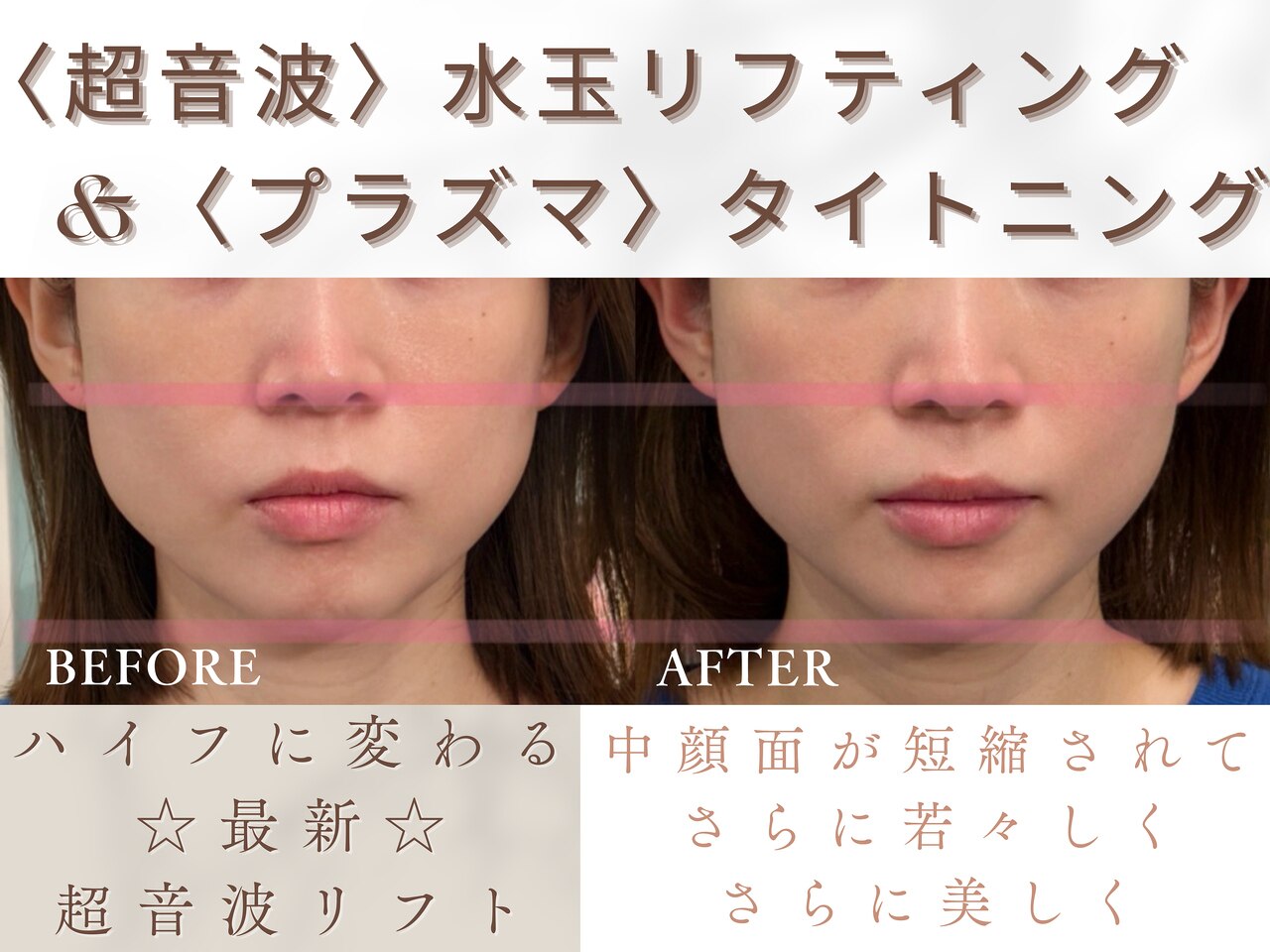 水玉リフト 水玉 話題の エステ サロン 小顔 毛穴 超音波 ビューティー