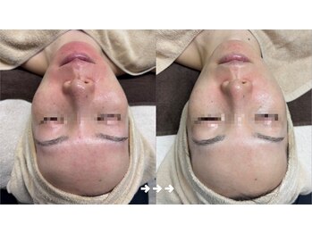 フロラスキン 銀座Blanc店(florasKIN)/肌質改善プログラム