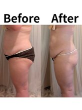 ポノ(pono)/WINBACK痩身★BeforeAfter