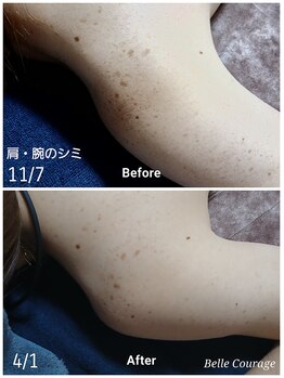 ベルクラージュ(Belle Courage)/30代 肩・腕のシミケア