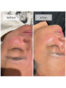 ヴィーナス(Venus)/ヒト幹細胞ピーリング　3回