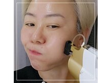 水光ピールスキン