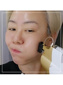 水光ピールスキンの写真/水光肌タンフル肌が目標★水光ピール組合せツヤふっくら肌作りコース充実★結果実感できる韓国人運営サロン