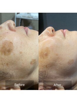 ハピエスト 田辺店/水光ピール