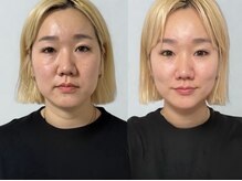 仙豆のちから 自由が丘店/テラボーラー1回の変化