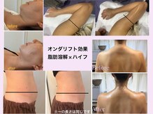 中部地区初！脂肪減少リフトでリバウンドしにくい体づくり！