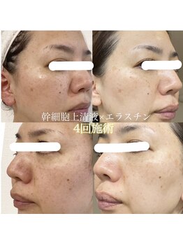 エミフル(emifull)の写真/【肌がキレイって言われるようになりました】シミ シワ たるみ くすみ トラブル肌等お肌のお悩みを根本改善