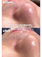 エムラボ 銀座店(M LABO)/ハイドロスキン