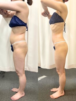 パラディ(PARADIS)の写真/【40代からの落ちないお腹に】ハイパーナイフ×ハイパーシェイプの集中痩身