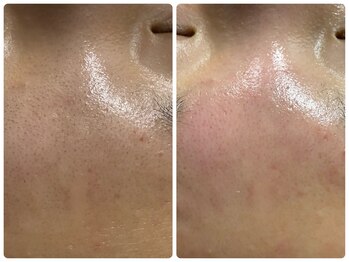 ルクシア(RUXCIA)/ビフォーアフター/部分wax脱毛