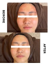 ゼロ(ZERO)/シミシワ肌質改善スペシャル