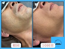 トミー(TOMMY)の雰囲気（美容効果もあるので肌荒れ防止、清潔感が格段にupします♪）