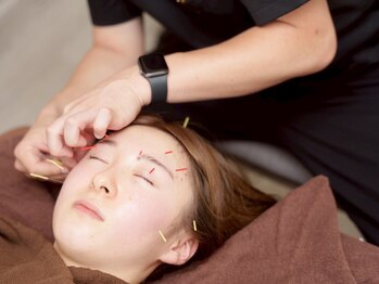 リアライズ(realise)/ ◆美容鍼/小顔/たるみ/しわ改善