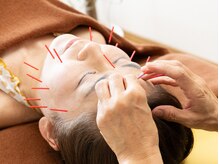 はな鍼灸院/総合的施術