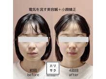 ハリサク/継続施術