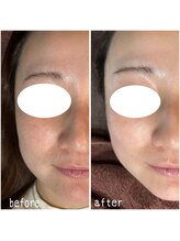 サロンドウルス(salon de ours)/光フェイシャル☆ before after